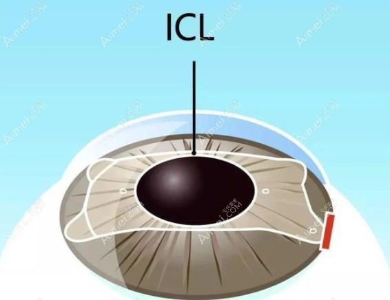 黄瑜斌医生解答白内障ICL晶体植入会有异物感吗m.aimei.com