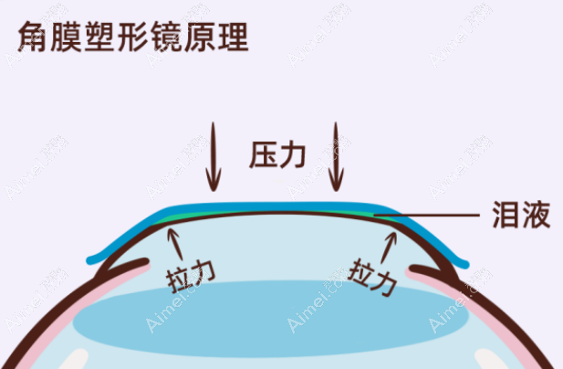 珠海儿童角膜塑形镜矫正近视价格5000-11000元起 珠海儿童角膜塑形镜矫正近视价格5000-11000元起