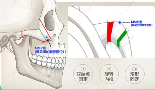 广州广大医院徐威强下颌角技术好 广州广大医院徐威强下颌角技术好