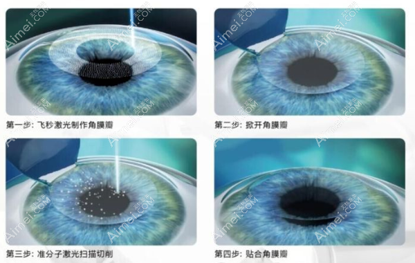 北京爱尔眼科半飞秒近视手术多少钱