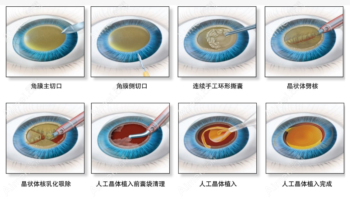 西安白内障手术价格 西安白内障手术价格