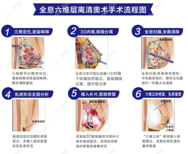 广州荔湾医院取奥美定取出技术好 广州荔湾医院取奥美定取出技术好