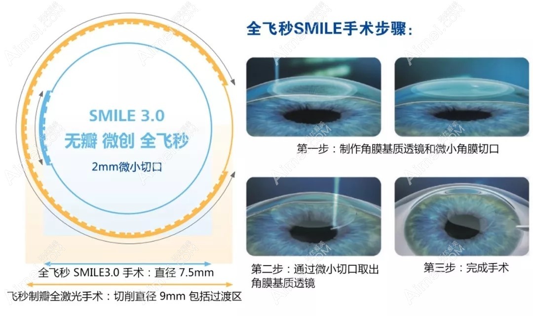 潍坊眼科医院全飞秒手术费用 潍坊眼科医院全飞秒手术费用
