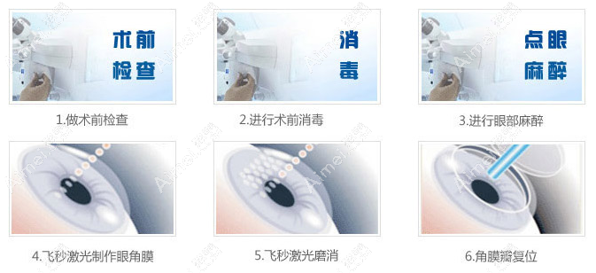 温州激光近视手术费用多少钱 温州激光近视手术费用多少钱