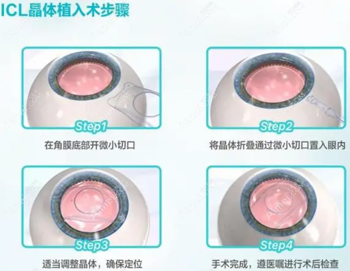 温州icl晶体植入手术多少钱 温州icl晶体植入手术多少钱