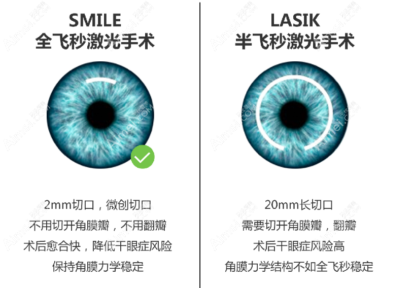 全飞秒手术和半飞秒手术区别 全飞秒手术和半飞秒手术区别