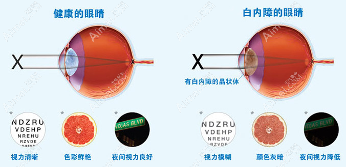 北京白内障超声乳化晶体摘除手术价格 北京白内障超声乳化晶体摘除手术价格
