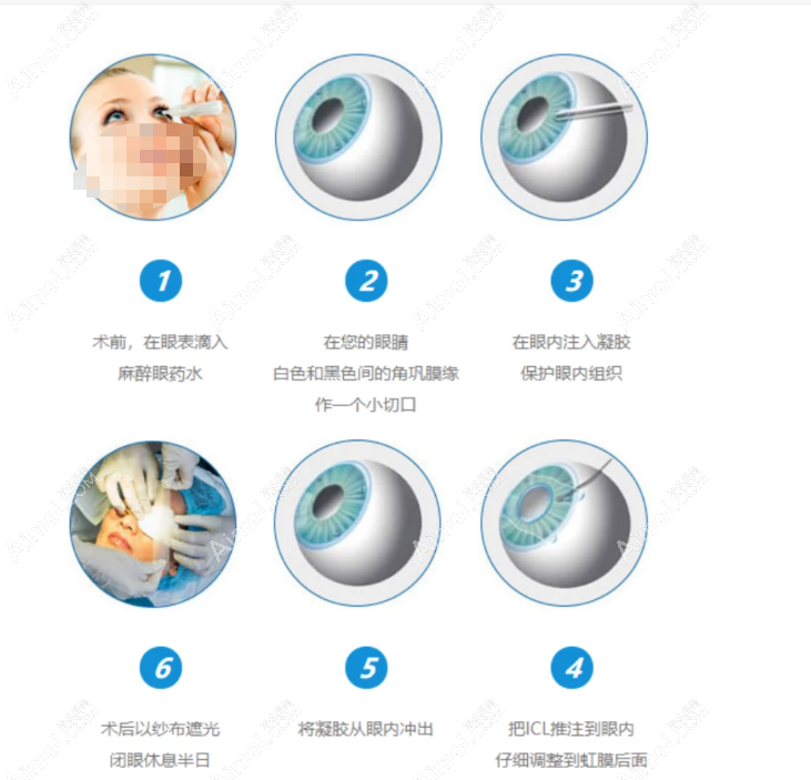 ICL晶体植入近视眼手术过程和步骤 ICL晶体植入近视眼手术过程和步骤