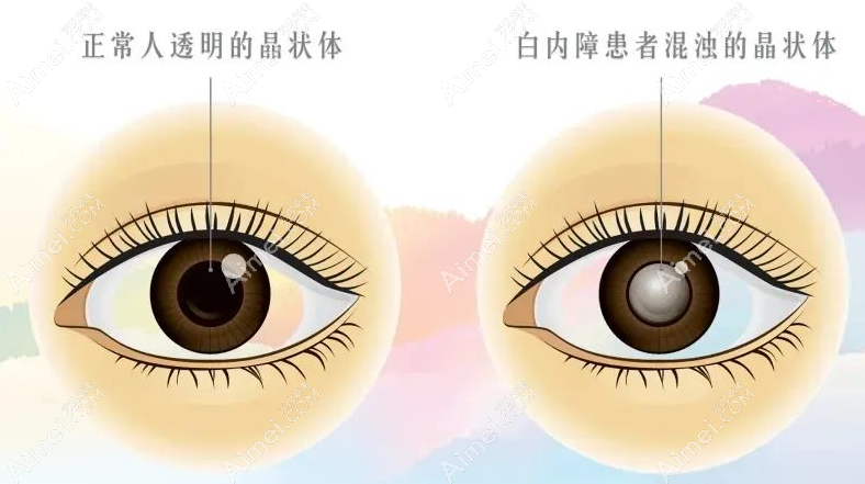 北京白内障人工晶体植入手术多少钱 北京白内障人工晶体植入手术多少钱