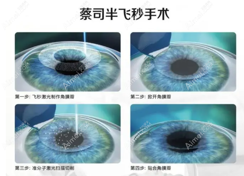 半飞秒手术过程和步骤 半飞秒手术过程和步骤