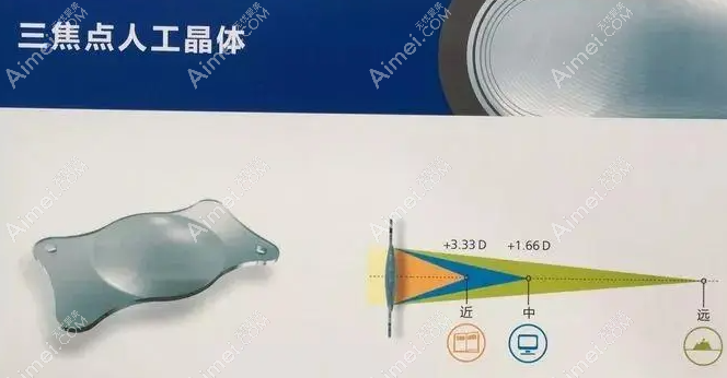 北京白内障三焦点人工晶体植入手术价格多少钱 北京白内障三焦点人工晶体植入手术价格多少钱