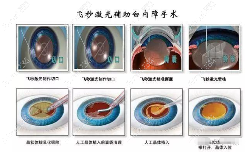 西安白内障人类光学人工晶体价格表 西安白内障人类光学人工晶体价格表