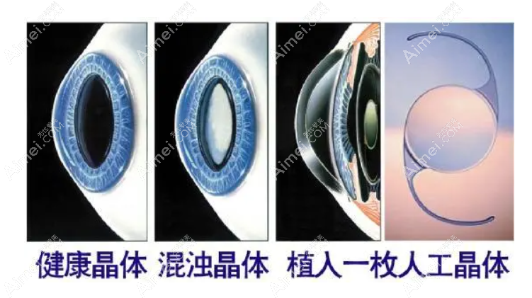 西安白内障Lenstec福来视人工晶体价格表 西安白内障Lenstec福来视人工晶体价格表