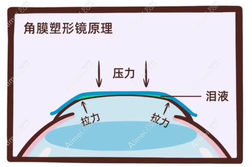 深圳阿尔法角膜塑形镜优势及原理 深圳阿尔法角膜塑形镜优势及原理