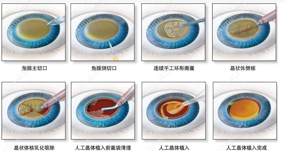 西安白内障爱尔康人工晶体价格表 西安白内障爱尔康人工晶体价格表
