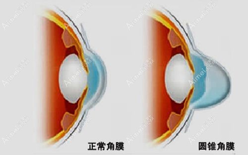 圆锥角膜是什么原因形成的 圆锥角膜是什么原因形成的
