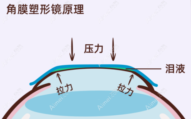 戴8年角膜塑形镜的体会和感受:控制近视好,8年度数只涨了150°