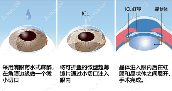 李海燕做ICL晶体植入技术好 李海燕做ICL晶体植入技术好