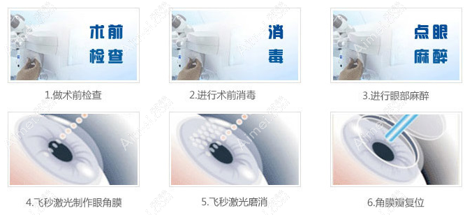 重庆何氏眼科医院激光近视手术多少钱 aimei.com