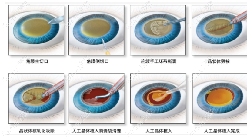 昆明华厦眼科医院白内障手术好的医生是谢柏林和陈斌