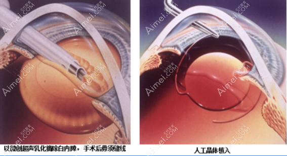 福州白内障超声乳化+人工晶体植入手术
