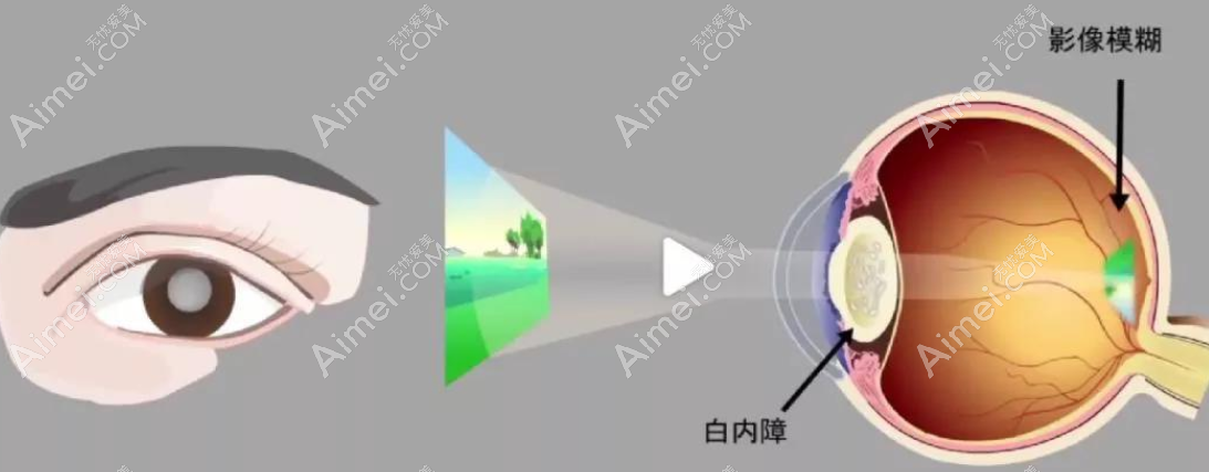 长沙白内障手术免费人群 长沙白内障手术免费人群