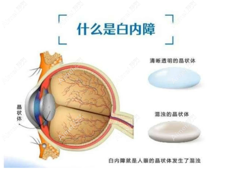 常见白内障类型及治疗方法:老年白内障/老花眼白内障有区别