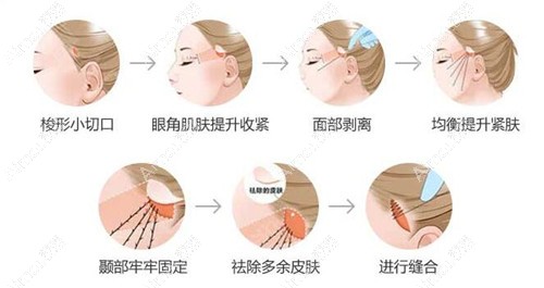 刘玉刚拉皮手术过程