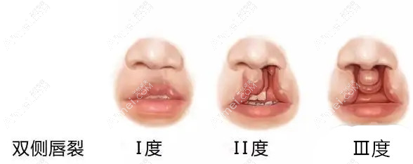 广州高尚唇裂修复技术好 广州高尚唇裂修复技术好