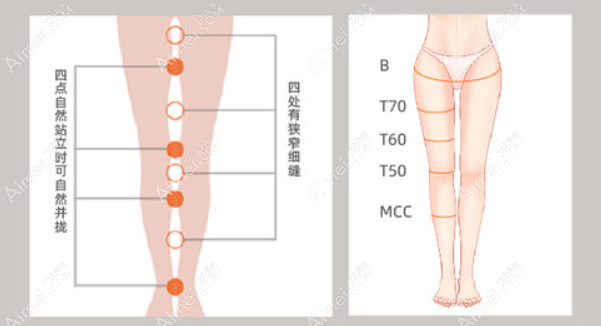 北京禾美嘉整形做腿型矫正手术好吗 北京禾美嘉整形做腿型矫正手术好吗
