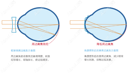 韩国露晰得ok镜设计原理 韩国露晰得ok镜设计原理