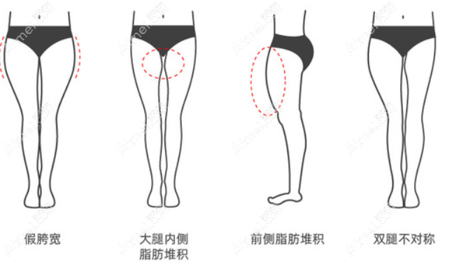 北京艺美整形矫正XO型腿怎么样 北京艺美整形矫正XO型腿怎么样