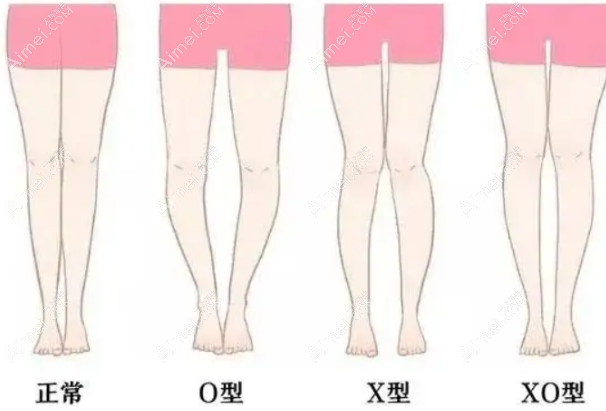 北京腿型矫正医院哪家好?北京XO型腿矫正排名前五医院推荐