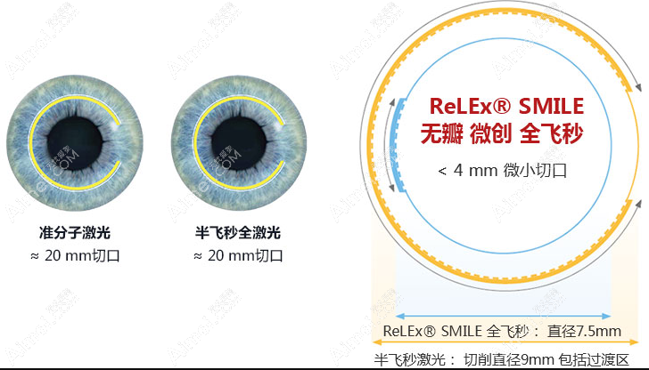 新视界眼科做激光近视8800+ 新视界眼科做激光近视8800+