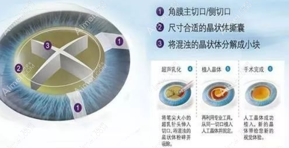 白内障飞秒激光晶体植入手术过程 白内障飞秒激光晶体植入手术过程