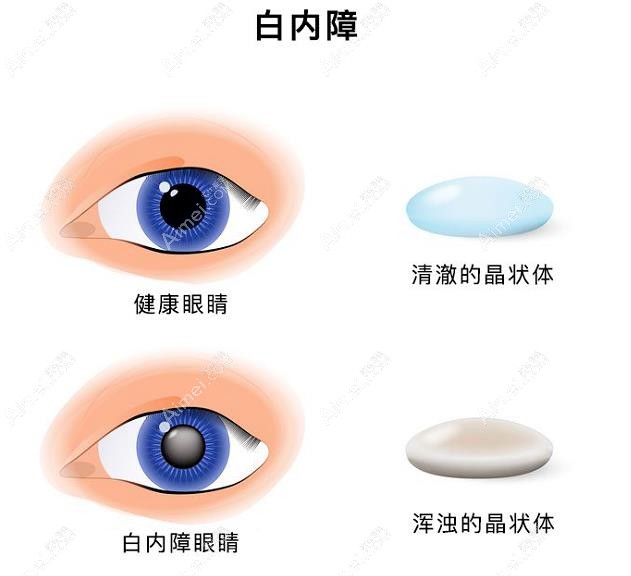 人工晶体不可以两眼不同dlren.com