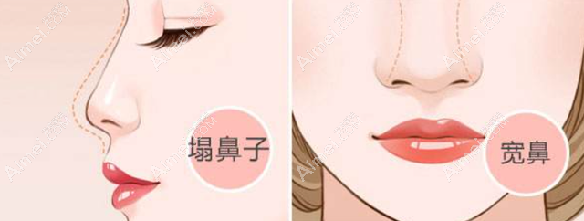汉中华美奥莱谁做鼻子做的好 汉中华美奥莱谁做鼻子做的好