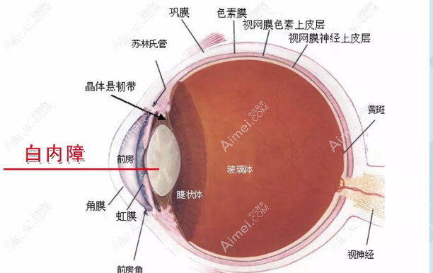 70岁老人白内障手术选择哪种人工晶体好 70岁老人白内障手术选择哪种人工晶体好