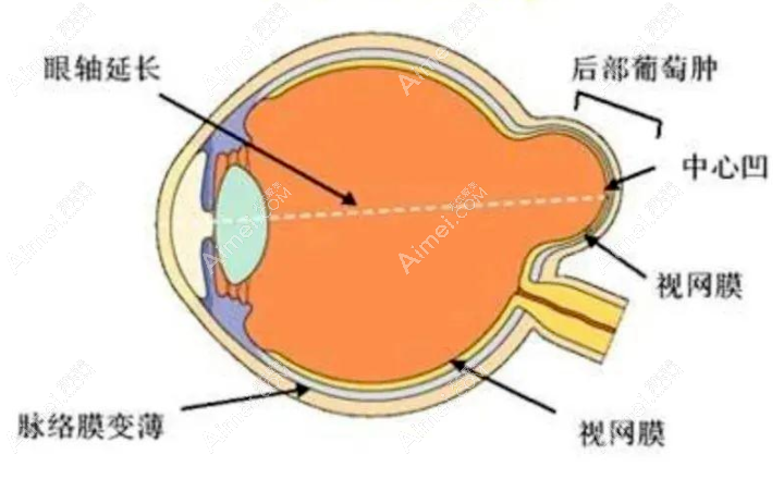 近视做后巩膜加固术大概费用多少钱?9000起,可控制近视增长