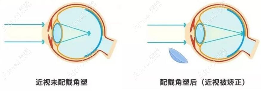 常州配角膜塑形镜选正规眼科疗效好 常州配角膜塑形镜选正规眼科疗效好
