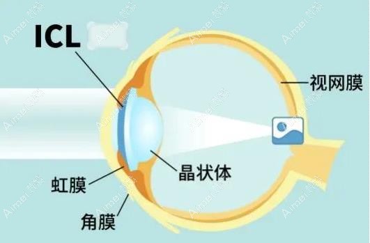武汉icl晶体植入手术好的医院排名前三推荐 武汉icl晶体植入手术好的医院排名前三推荐