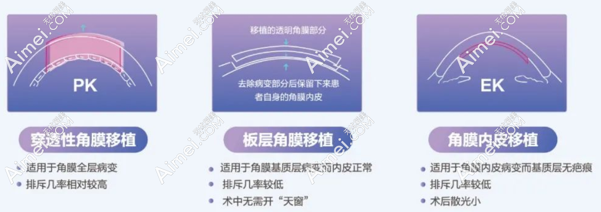 角膜移植手术3种方法恢复时间不同 角膜移植手术3种方法恢复时间不同
