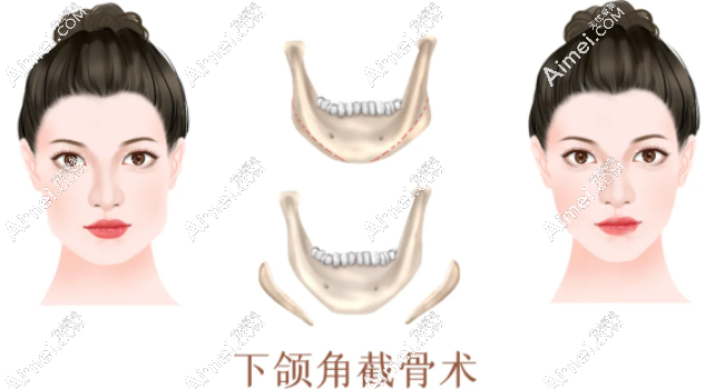 北京圣嘉新医院磨骨价格表 北京圣嘉新医院磨骨价格表