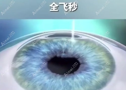 全飞秒第二天视力达到0.8算正常吗爱美网