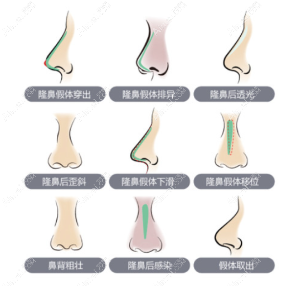 李信锋鼻整形价格
