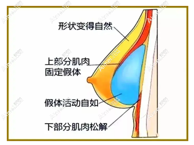 李高峰隆胸成效好包膜挛缩率低 李高峰隆胸成效好包膜挛缩率低