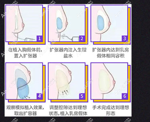 李高峰隆胸包膜挛缩率低 李高峰隆胸包膜挛缩率低