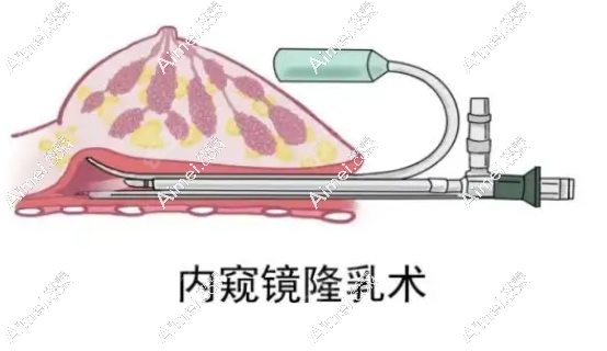 出彩医美十分钟隆胸真的靠谱不是骗局,恢复的快价格4万起