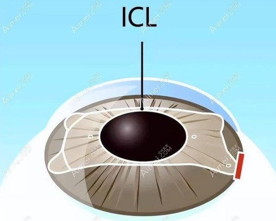 李志华做icl晶体近视手术好www.ai/mei.com