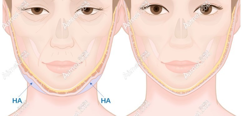 打面部馒化修复收紧针消除馒化脸对比图片爱美网 打面部馒化修复收紧针消除馒化脸对比图片爱美网
